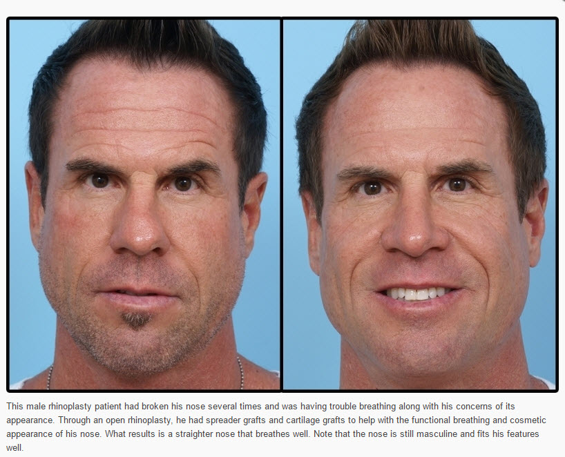 Male Plastic Surgery Temecula Murietta