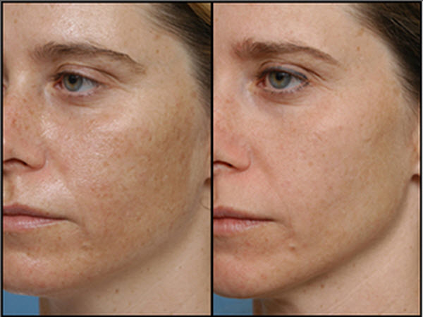 chemical peel before and after results