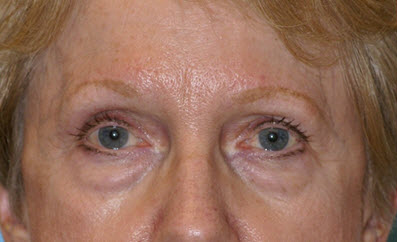 Eye Rejuvenation