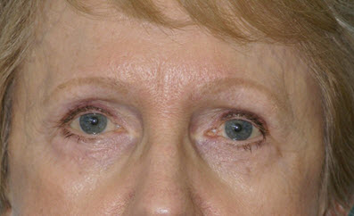 Eye Rejuvenation