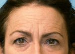 Brow Lift