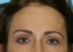 Brow Lift