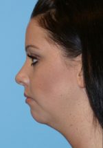 Chin Implants