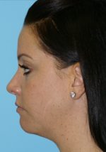 Chin Implants