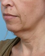 Face Lift/ Mini Lift/ Neck Lift