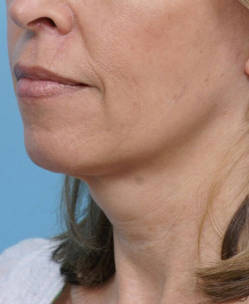 Face Lift/ Mini Lift/ Neck Lift