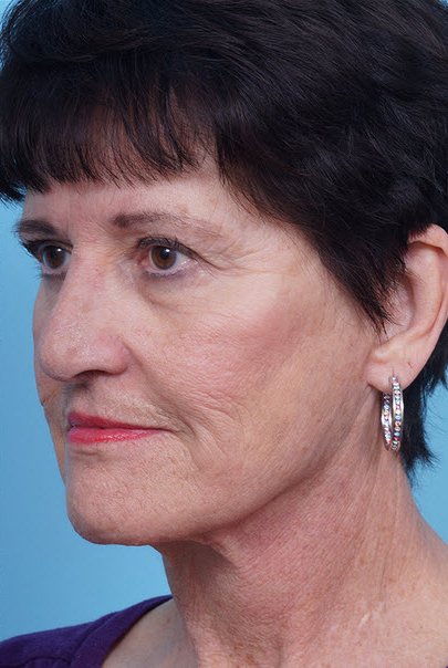 Face Lift/Neck Lift