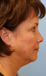 Face Lift/Neck Lift