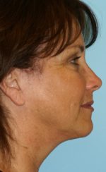 Face Lift/Neck Lift