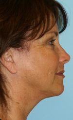 Face Lift/ Mini Lift/ Neck Lift