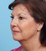 Face Lift/Neck Lift