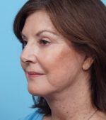 Face Lift/Neck Lift