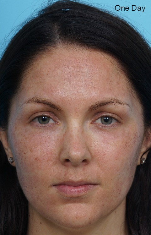 Laser/Chemical Peel