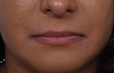 Lip Augmentation/Injectables