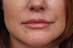 Lip Augmentation/Injectables