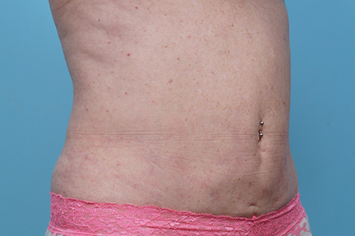 CoolSculpting