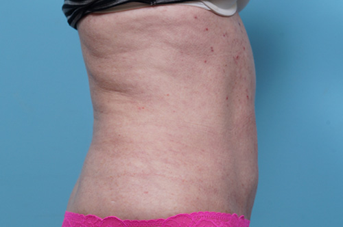 CoolSculpting