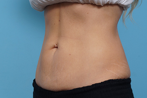 CoolSculpting