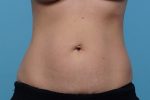 CoolSculpting