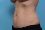 CoolSculpting