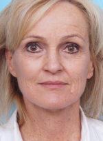 Face Lift/Neck Lift