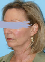 Face Lift/ Mini Lift/ Neck Lift