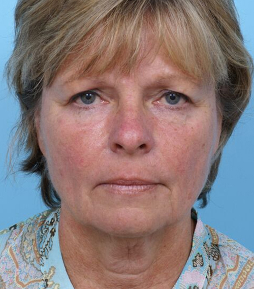 Face Lift/Neck Lift