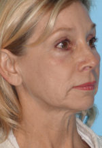 Face Lift/ Mini Lift/ Neck Lift