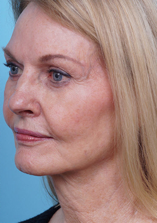 Face Lift/Neck Lift