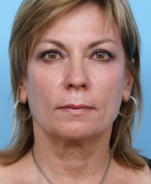 Face Lift/Neck Lift