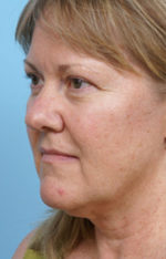 Face Lift/Neck Lift