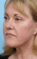 Face Lift/Neck Lift