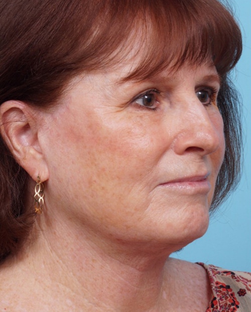 Face Lift/Neck Lift