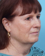 Face Lift/Neck Lift