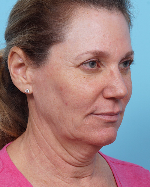 Face Lift/ Mini Lift/ Neck Lift