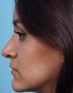 Rhinoplasty