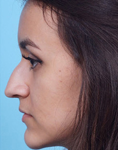 Rhinoplasty