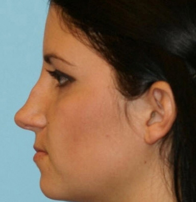 Rhinoplasty