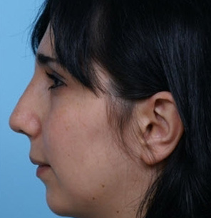 Rhinoplasty