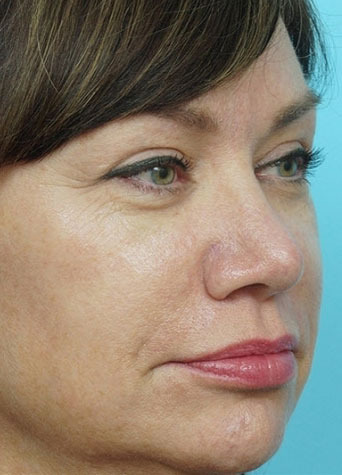 Rhinoplasty