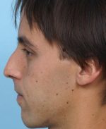 Rhinoplasty