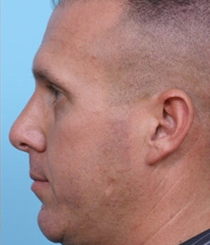 Rhinoplasty