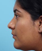 Rhinoplasty