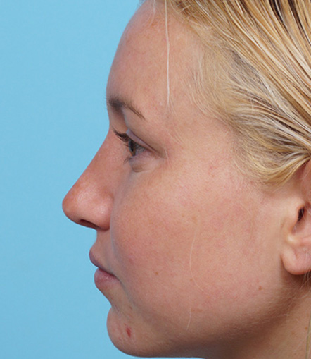 Rhinoplasty