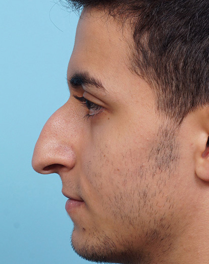 Rhinoplasty