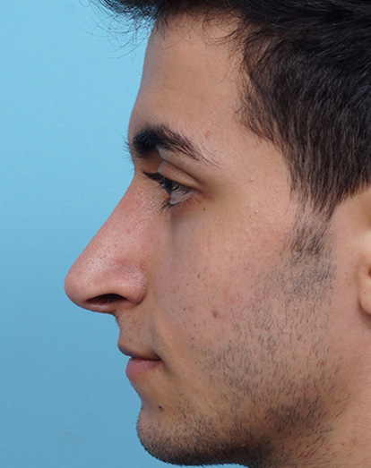 Rhinoplasty