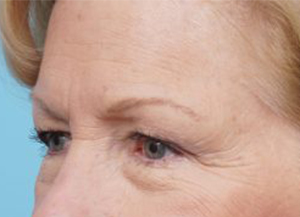 Brow Lift