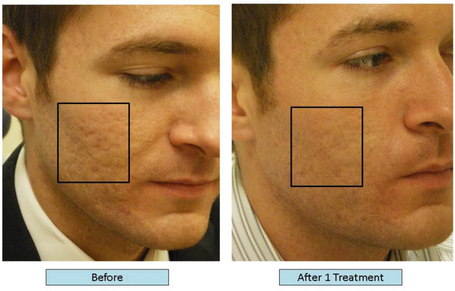 Dr Richard Balikian Now Can Treat Acne Scars With Lasers And