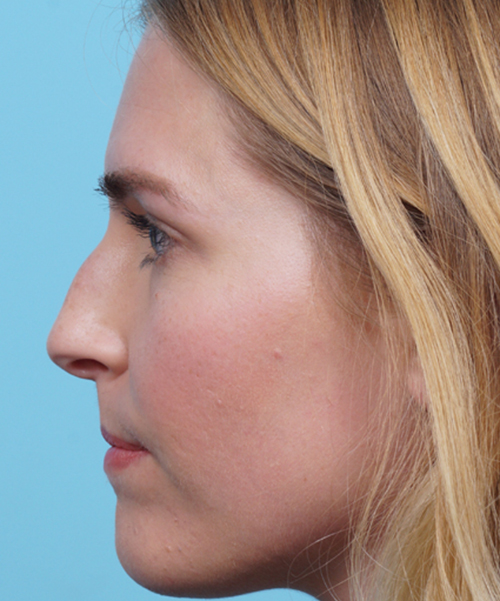 Rhinoplasty