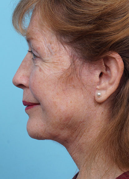 Face Lift/ Mini Lift/ Neck Lift